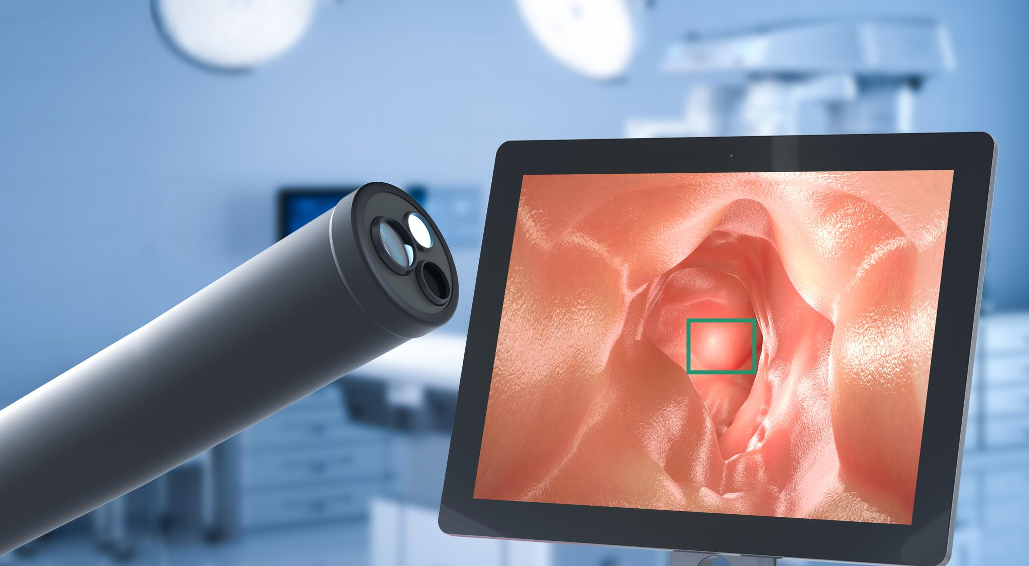 An AI-assisted endoscopy system flagging a suspected lesion